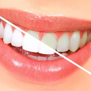 مواد ومستلزمات تبييض الأسنان